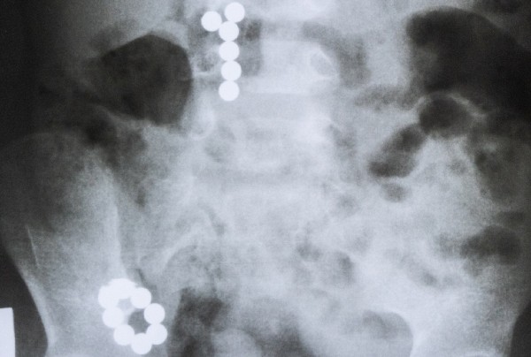 Опасная игрушка: в Челябинске у маленького ребенка из живота достали 14 магнитов Опасная игрушка: в Челябинске у маленького ребенка из живота достали 14 магнитов