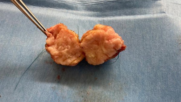 Размером с желудочек: в Челябинске у младенца удалили огромную опухоль сердца Размером с желудочек: в Челябинске у младенца удалили огромную опухоль сердца