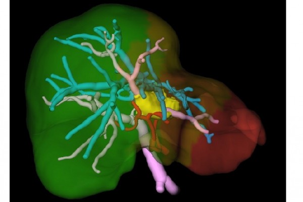 В Челябинске пациенту удалили опухоль в печени с использованием холода В Челябинске пациенту удалили опухоль в печени с использованием холода
